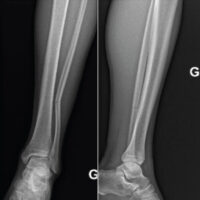 Figure 1: Initial radiographs showing a left distal fibular fracture.