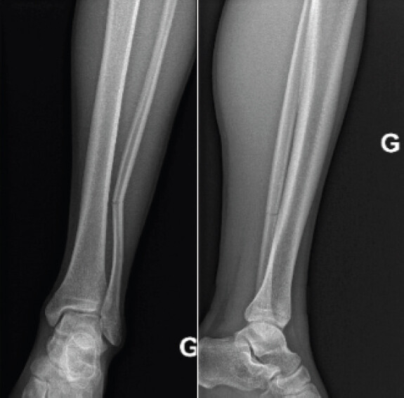 Figure 1: Initial radiographs showing a left distal fibular fracture.