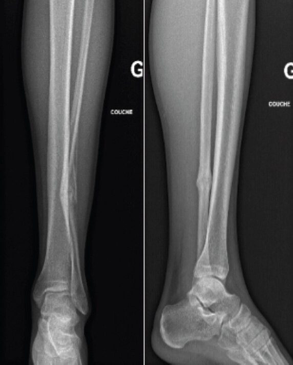 Figure 2: Follow-up radiographs at 4 months showing a persisting fracture line.