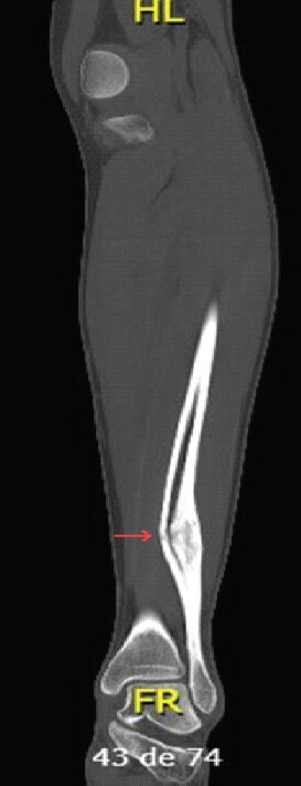 Figure 3: Computed tomography scan showing a large hypertrophic callus.