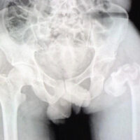 Figure 1: Pre-operative X-ray.