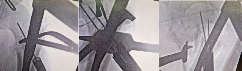 Figure 3: Fluoroscopic images.