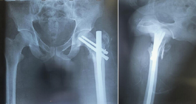 Figure 4: Post-operative X-ray.