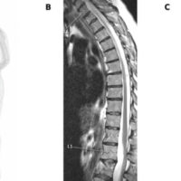 Figure 1: Oncologic spine imaging at presentation. (a) Whole-body positron emission tomography-computed tomography maximum-intensity projection showing multifocal hypermetabolic osteolytic lesions across the axial skeleton. (b) Sagittal thoracolumbar magnetic resonance imaging showing metastatic vertebral involvement. (c) Anteroposterior thoracolumbar radiograph after previous vertebral augmentation.
