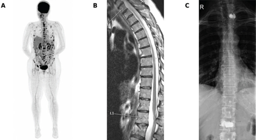 Figure 1: Oncologic spine imaging at presentation. (a) Whole-body positron emission tomography-computed tomography maximum-intensity projection showing multifocal hypermetabolic osteolytic lesions across the axial skeleton. (b) Sagittal thoracolumbar magnetic resonance imaging showing metastatic vertebral involvement. (c) Anteroposterior thoracolumbar radiograph after previous vertebral augmentation.