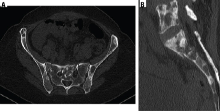 Figure 2: Pre-operative sacral fracture imaging. (a) Axial pelvic computed tomography showing bilateral sacral ala involvement. (b) Sagittal computed tomography reconstruction demonstrating the transverse sacral component, consistent with an H-shaped pathological sacral fracture.
