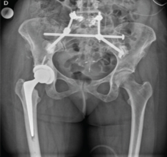 Figure 3: Post-operative spinopelvic fixation. Anteroposterior pelvic radiograph showing the combined construct: A transiliac-transsacral screw crossing the S1 corridor and a minimally invasive lumbopelvic fixation with bilateral L5 pedicle and cement-augmented S2-alar-iliac screws connected by precontoured rods; a right total hip arthroplasty is also visible.