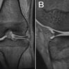 Double-Layered Lateral Meniscus Mimicking Locking of Lateral Meniscus: A Case Report