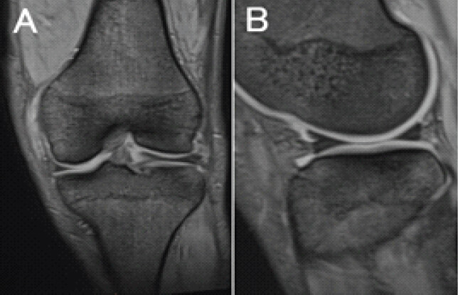 Figure 1: Magnetic resonance imaging (MRI). (a) Coronal T2-weighted MRI image demonstrating apparent locking of the lateral meniscus. (b) Sagittal T2-weighted MRI image showing increased thickness and signal alteration in the anterior segment of the lateral meniscus. The inner margin of the meniscus appears sharp.