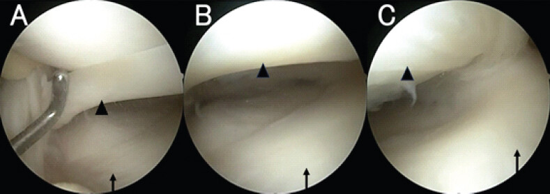 Figure 2: Arthroscopic image of lateral meniscus. (a) An unstable meniscus is observed overlying the normal lateral meniscus. Arrow head indicates the accessory meniscus. Arrow indicates anterior segment of normal lateral meniscus. (b) Arrow head indicates the accessory meniscus. Arrow indicates from the anterior segment to the middle segment of normal lateral meniscus. (c) Arrow head indicates the accessory meniscus. Arrow indicates middle segment of normal lateral meniscus.