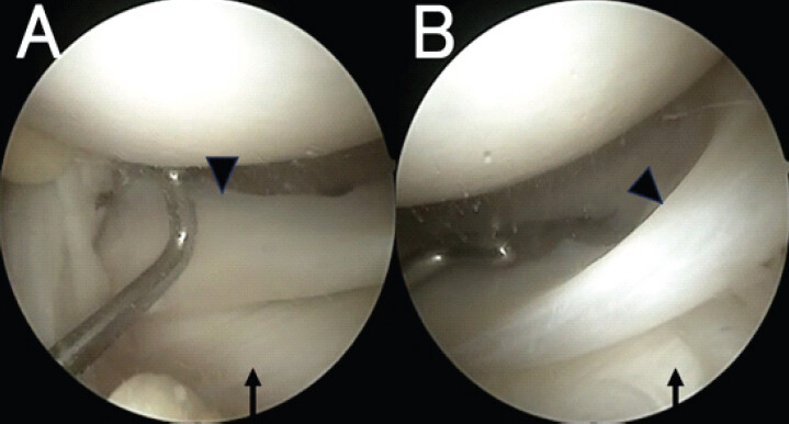 Figure 3: Arthroscopic image which shows that the accessory meniscus overlying normal lateral meniscus is unstable. (a) Arrow head indicates the accessory meniscus. Arrow indicates anterior segment of normal lateral meniscus. (b) Arrow head indicates the accessory meniscus. Arrow indicates middle segment of normal lateral meniscus.