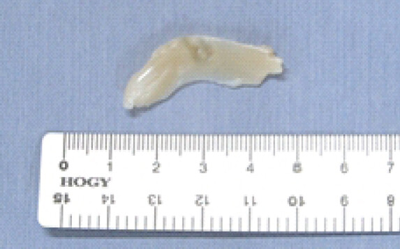 Figure 4: Resected unstable meniscus. The superior unstable layer was resected entirely.