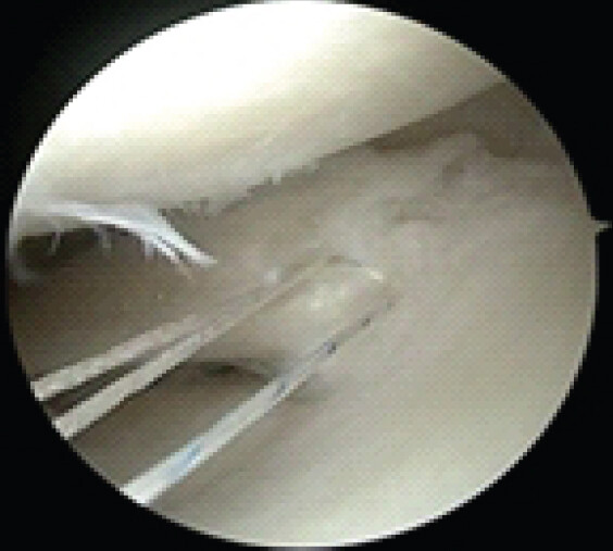 Figure 5: Arthroscopic image after resection. Arthroscopic image of the lateral meniscus after resection of the accessory meniscus and repairing the horizontal tear which was not identified on magnetic resonance imaging.