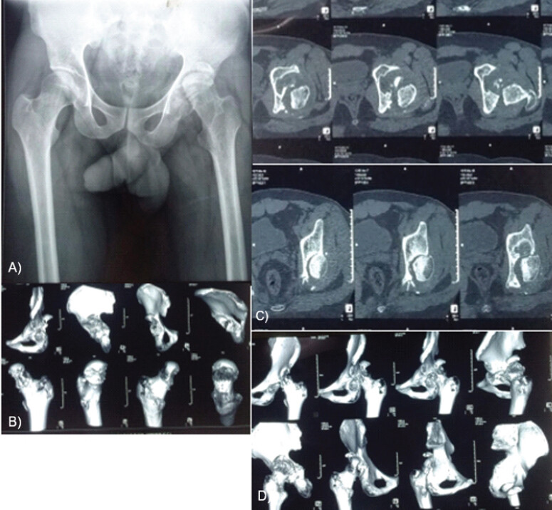 Figure 1: (a, b, c and d) Pre-operative radiograph and computed tomography scans of patient (Case 1) at presentation.