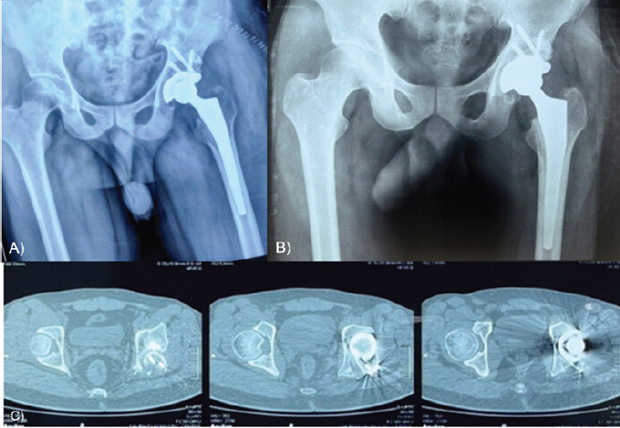Figure 2: (a, b and c) Post-operative radiograph of patient (Case 1) and follow-up radiograph and computed tomography scan showing a retroverted acetabular cup of patient (Case 1) at 12 months.