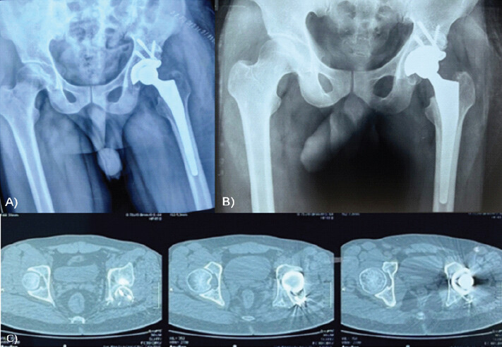 Figure 3: (a, b and c) Pre-operative radiograph and computed tomography scans of patient (Case 2) at presentation