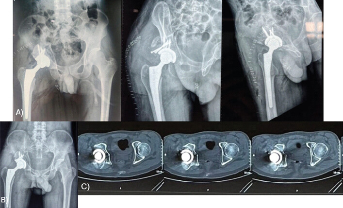 Figure 4: (a, b and c) Post-operative radiographs of patient (Case 2) and follow-up radiograph and CT scan showing retroverted acetabular cup of patient (Case 2) at 12 months.