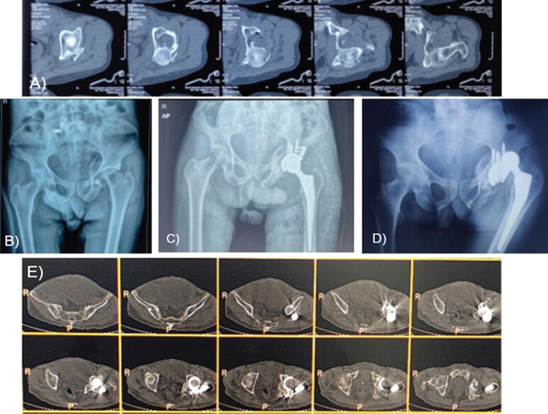 Figure 5: (a, b, c, d and e) Pre-operative computed tomography (CT) scans and radiograph of the patient (Case 3) at presentation and post-operative radiograph of the patient and 2-month follow-up radiograph and CT scans of the patient.