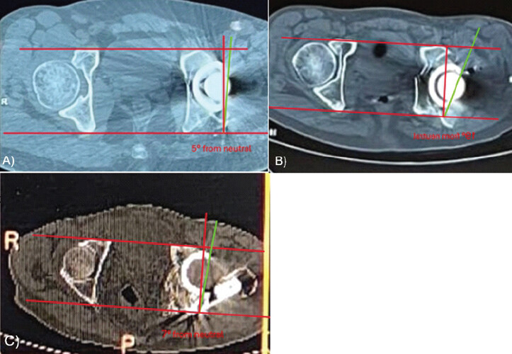 Figure 6: (a, b and c) Measuring retroversion in computed tomography scans of Case 1, Case 2, and Case 3.