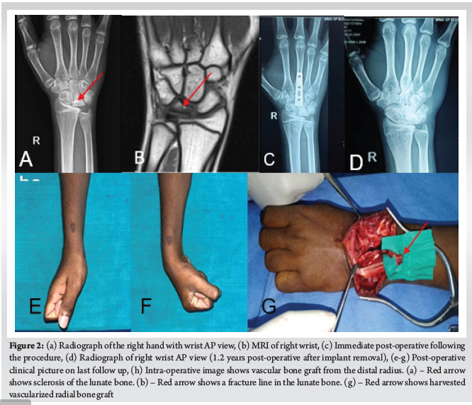 Bone Grafting and Unloading Procedures for Stage 1–3a Kienbock’s ...