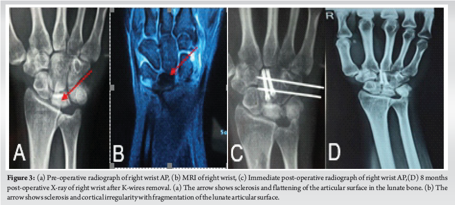 Bone Grafting and Unloading Procedures for Stage 1–3a Kienbock’s ...