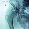 Total Hip Arthroplasty with Cage Application for Complex Posterior Hip Dislocation and Acetabular Fracture in a Patient with Prior Patellectomy: A Case Report