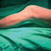 Hoffa Fracture Non-union Treated with Medial Parapatellar Approach and Headless Compression Screw Fixation: A Case Report