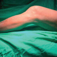 Figure 1: Clinical photograph demonstrating the fixed flexion deformity, with flexion possible to 90°.