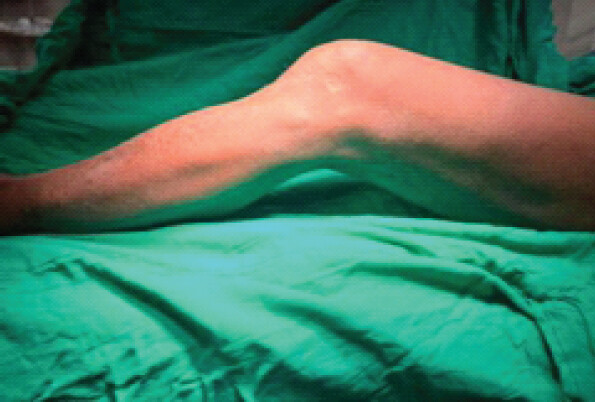 Figure 1: Clinical photograph demonstrating the fixed flexion deformity, with flexion possible to 90°.