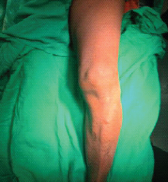 Figure 2: Clinical photograph of the affected limb showing the extension deficit corresponding to the fixed flexion deformity of 30°.