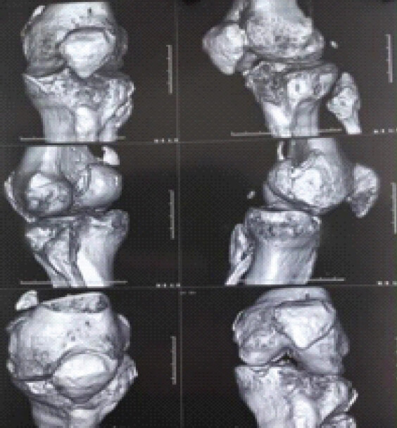Figure 3: Pre-operative three-dimensional volume-rendered computed tomography reconstruction of the knee in multiple projections, demonstrating the coronal fracture plane, fragment displacement, and articular incongruity.
