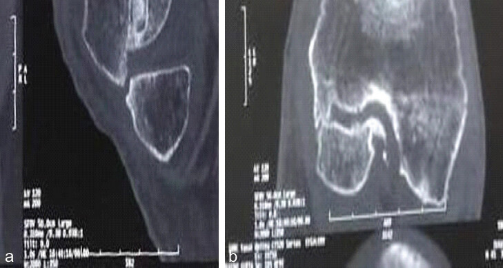 Figure 4: (a) Sagittal bone-window computed tomography (CT) reconstruction showing the displaced coronal (Hoffa) fragment with sclerotic, well-defined non-union margins and a persistent radiolucent gap. (b) Axial CT slice through the femoral condyle showing the fracture line, articular incongruity, and adjacent subchondral sclerosis.