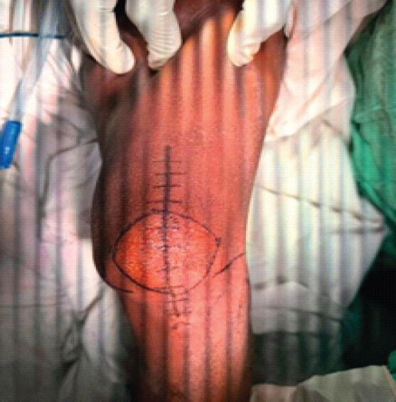 Figure 5: Medial parapatellar skin incision and wound closure.