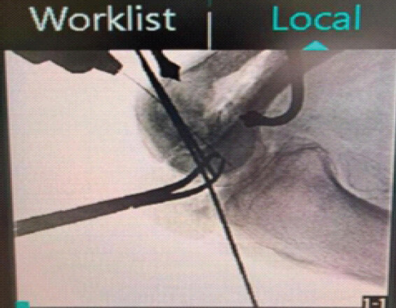 Figure 6: Intraoperative fluoroscopic image showing the guide wire directed across the reduced fragment prior to headless compression screw placement.