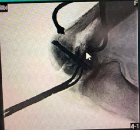 Figure 7: Intraoperative fluoroscopic image demonstrating provisional guide-wire fixation used to confirm trajectory before definitive screw placement.