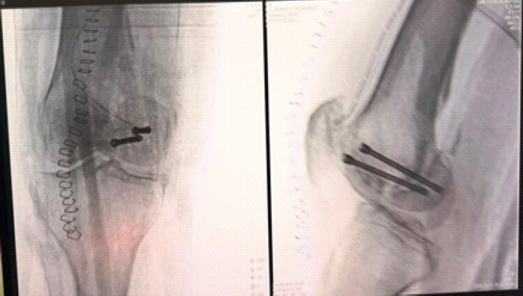 Figure 8: Final intraoperative fluoroscopic images (anteroposterior and lateral) confirming reduction and position of the two parallel headless compression screws.