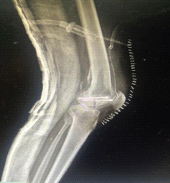 Figure 9: Post-operative radiograph showing anatomical reduction of the condylar fragment with two parallel headless compression screws.