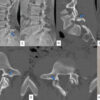 Triple Procedure for Direct Pars Repair: An Innovative, Non-fusion Approach for Managing Spondylolysis in Late Adolescence or Early Adulthood