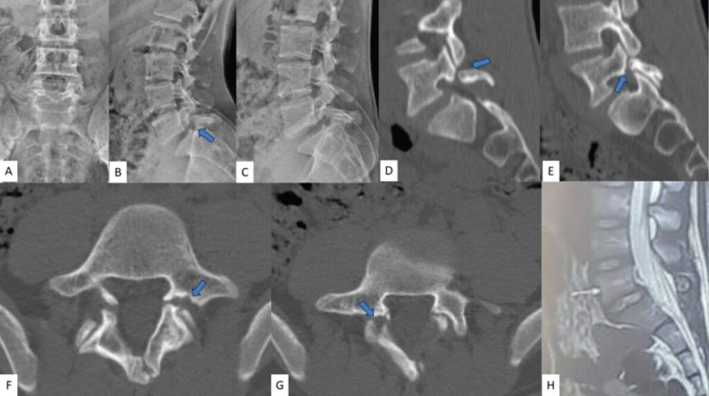 Figure 1: Pre-operative images. (a) Anteroposterior view of plain lumbar radiograph demonstrating mildly hypoplastic spinous process and adjacent lamina [spina bifida occulta], (b and c) dynamic radiographs – flexion and extension lateral views showing lytic defect in the L5 pars interarticularis with minimal intervertebral instability. (d and e) Computed tomography (CT) images showing right and left parasagittal views at the level of pars interarticularis indicating a chronic lytic pars defect with sclerotic margins. (f and g) Axial CT images showing chronic lytic pars defect with sclerotic margins and significant gap at L5 vertebra. (h) Mid-sagittal section of T2-weighted image (magnetic resonance imaging) scan depicting Pfirmann Grade 1 degeneration of L5-S1 disk space with no significant spinal canal compromise.