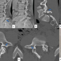 Figure 1: Pre-operative images. (a) Anteroposterior view of plain lumbar radiograph demonstrating mildly hypoplastic spinous process and adjacent lamina [spina bifida occulta], (b and c) dynamic radiographs – flexion and extension lateral views showing lytic defect in the L5 pars interarticularis with minimal intervertebral instability. (d and e) Computed tomography (CT) images showing right and left parasagittal views at the level of pars interarticularis indicating a chronic lytic pars defect with sclerotic margins. (f and g) Axial CT images showing chronic lytic pars defect with sclerotic margins and significant gap at L5 vertebra. (h) Mid-sagittal section of T2-weighted image (magnetic resonance imaging) scan depicting Pfirmann Grade 1 degeneration of L5-S1 disk space with no significant spinal canal compromise.