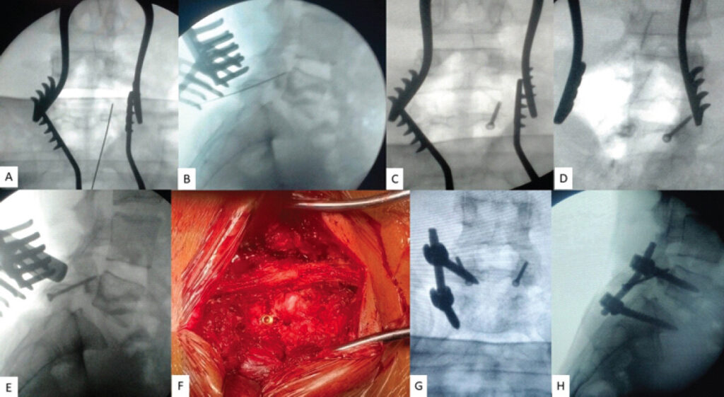 Figure 2: Intraoperative images. (a and b) Anteroposterior (AP) and lateral C-arm imaging showing the initial placement of intra-laminar guide-wire. (c, d and e) AP, oblique and lateral C-arm images showing final position of right intra-laminar screw placement. (f) Intraoperative photograph showing right intra-laminar screw in position and iliac crest bone graft at the site of the pars defect. (g and h) Final C-arm image after temporary inter-segmental pedicle screw-rod construct on the left side.