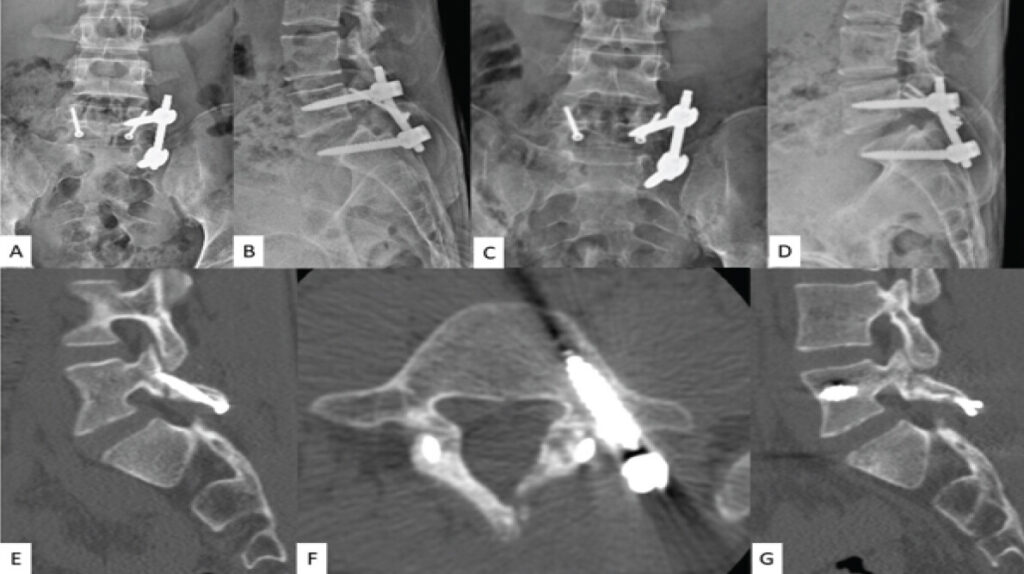 Figure 3: Post-operative images. (a and b) Anteroposterior (AP) and lateral plain radiographs showing satisfactory position of the final construct (triple procedure) at the immediate post-operative period. (c and d) AP and lateral plain radiographs at 12-month follow-up showing satisfactory position of implants. (e, f and g) computed tomography images showing right parasagittal, axial, and left parasagittal sections indicating good healing and satisfactory osseous replacement at the site of pars defect.