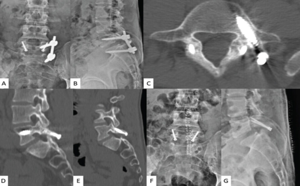 Figure 4: Final follow-up (24 months) images. (a and b) Anteroposterior (AP) and lateral plain radiographs showing satisfactory position of the implants. (c, d and e) Computed tomography images showing axial, right parasagittal and left parasagittal sections indicating excellent healing of the of pars defect. (f and g) AP and lateral plain lumbar radiographs after temporary pedicle screw-rod construct removal.