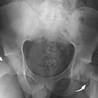 Figure 1: The right non-displaced and left displaced, medially comminuted, and varus-angulated femoral neck fractures.