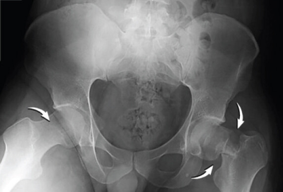 Figure 1: The right non-displaced and left displaced, medially comminuted, and varus-angulated femoral neck fractures.