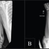 Open Posterolateral Elbow Dislocation in an Adult after Low-Energy Trauma: A Case Report Highlighting Diagnostic and Operative Considerations