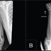 Figure 1: Initial injury radiographs. (a) Anteroposterior radiograph of the right elbow demonstrating posterolateral displacement of the proximal radius and ulna relative to the distal humerus, consistent with an acute elbow dislocation. Intra-articular air is visible within the ulnohumeral joint space. (b) Posterior projection showing persistent ulnohumeral malalignment and widening of the joint space.