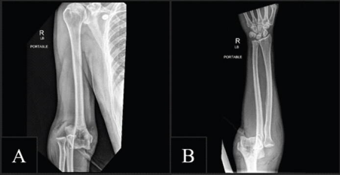 Figure 1: Initial injury radiographs. (a) Anteroposterior radiograph of the right elbow demonstrating posterolateral displacement of the proximal radius and ulna relative to the distal humerus, consistent with an acute elbow dislocation. Intra-articular air is visible within the ulnohumeral joint space. (b) Posterior projection showing persistent ulnohumeral malalignment and widening of the joint space.