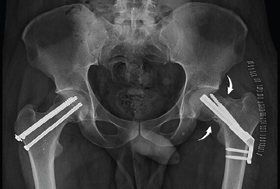 Figure 2: The left displaced fracture has been stabilized with Femoral Neck System and supplemental screw fixation.