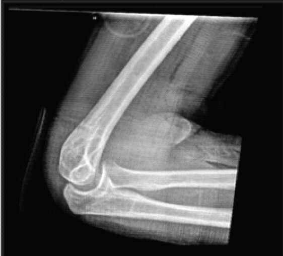 Figure 2: Post-reduction lateral radiograph. Lateral radiograph obtained after closed reduction with the elbow splinted, demonstrating improved ulnohumeral alignment.